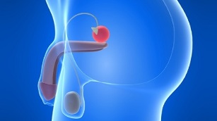 prostatako masajea prostatitisa prebenitzeko