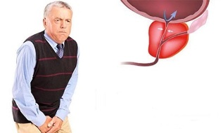 prostatitis sintomak gizonezkoetan