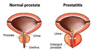 akutua prostatitis tratamendua