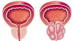 prostatitisa eta prostatako adenoma garatzeko arrazoiak