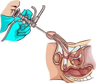 Ureteroskopia prozedura